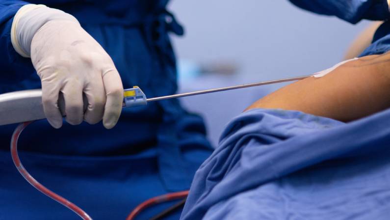 is liposuction painful