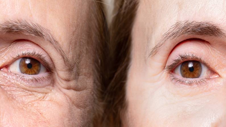 what to expect from botox