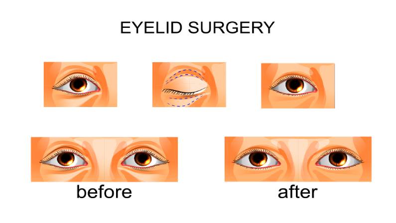 eyelid surgery