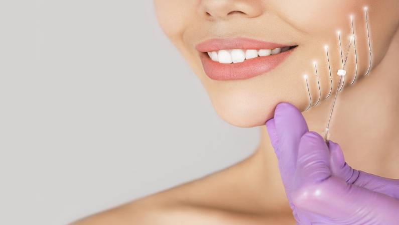 Facelift procedure using mesothreads