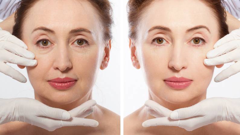 Face lifting, anti aging concept