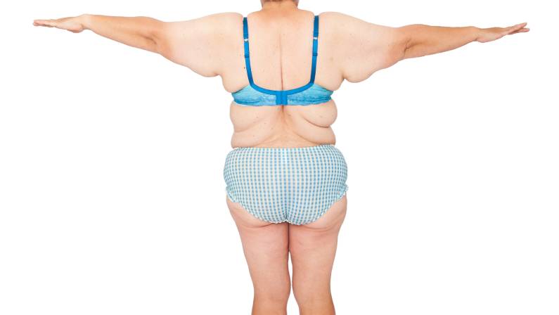 Middle aged woman before brachioplasty, panniculectomy, abdominoplasty and mummy makeover.