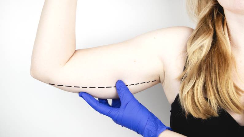 A plastic surgeon is preparing to tighten the skin of the hands.