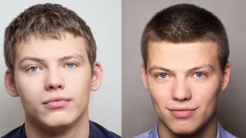 otoplasty - before and after the operation