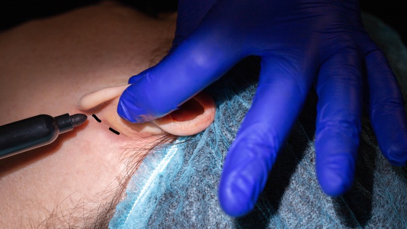 A plastic surgeon performs an operation to correct the ears of a female patient.