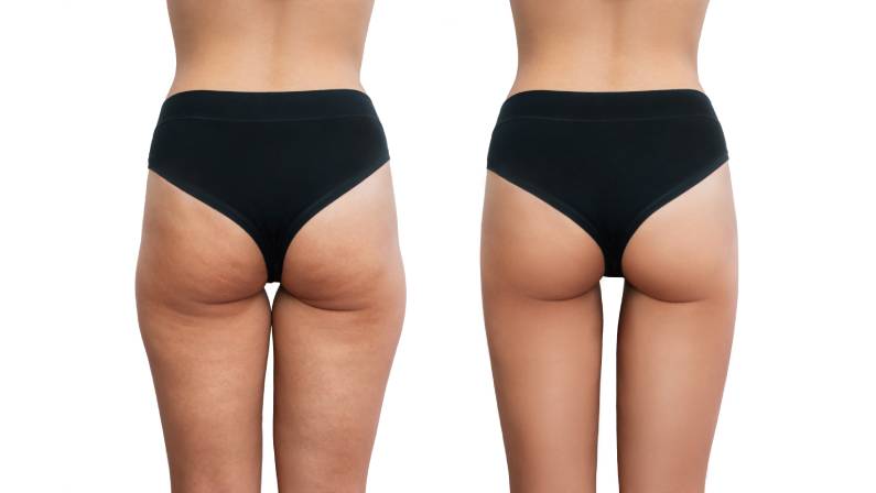 before and after thigh lift surgery