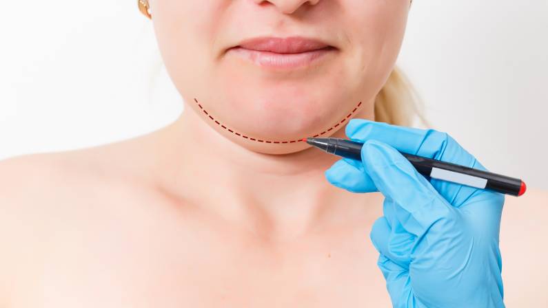 Chin reduction augmentation