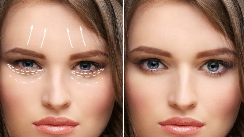 surgical brow lift before and after