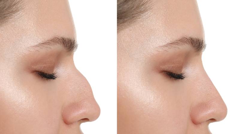 Woman before and after rhinoplasty on white background