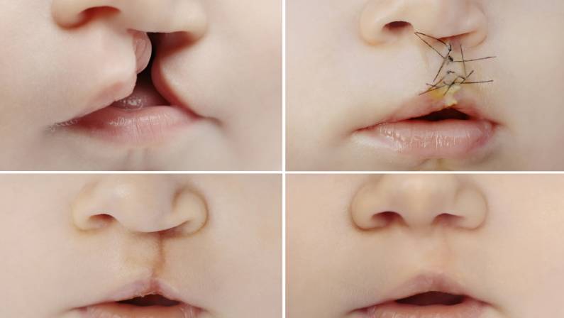 Closeup on lips of baby with lip and palate cleft before and after surgery.