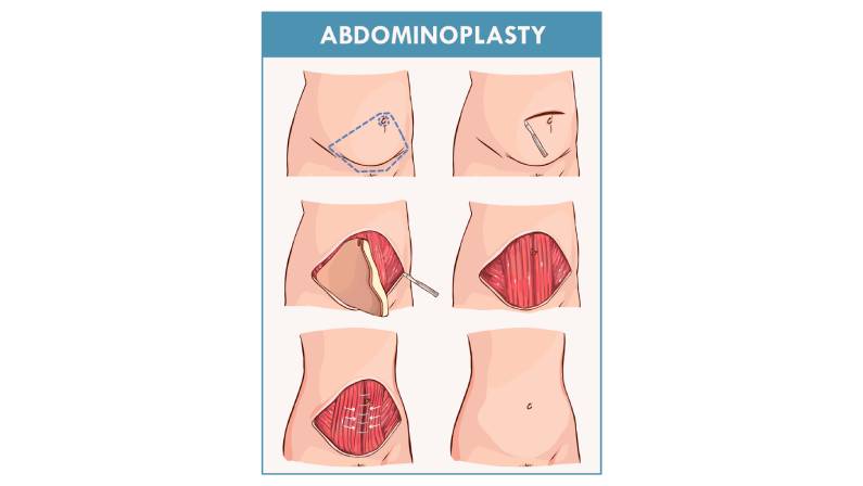 Abdominoplasty Procedure