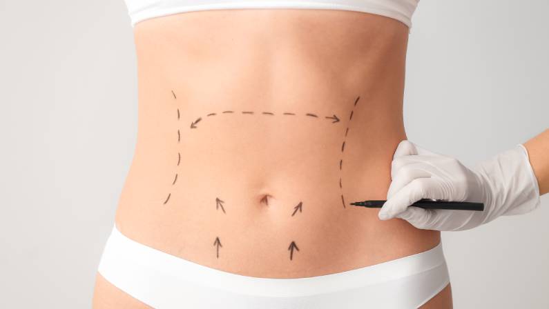 Plastic surgeon applying marks on female body