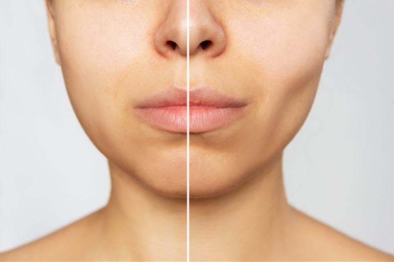 Cropped shot of young caucasian woman before and after plastic surgery buccal fat pad removal