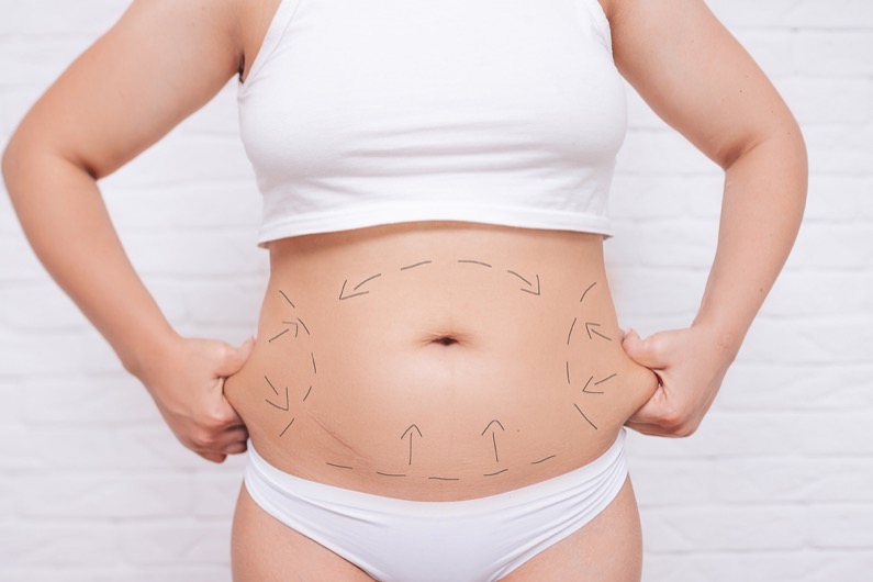 a plastic surgeon marks a woman's body for surgery to correct the figure.