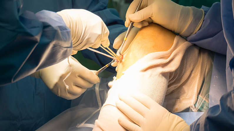 Preparation tendon For ACLR