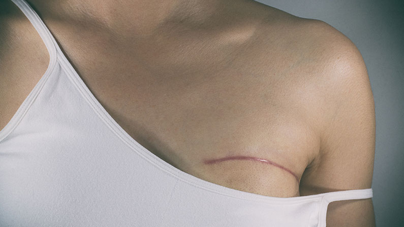 Close-up of a healed surgical scar below the chest following successful breast reconstruction surgery recovery.