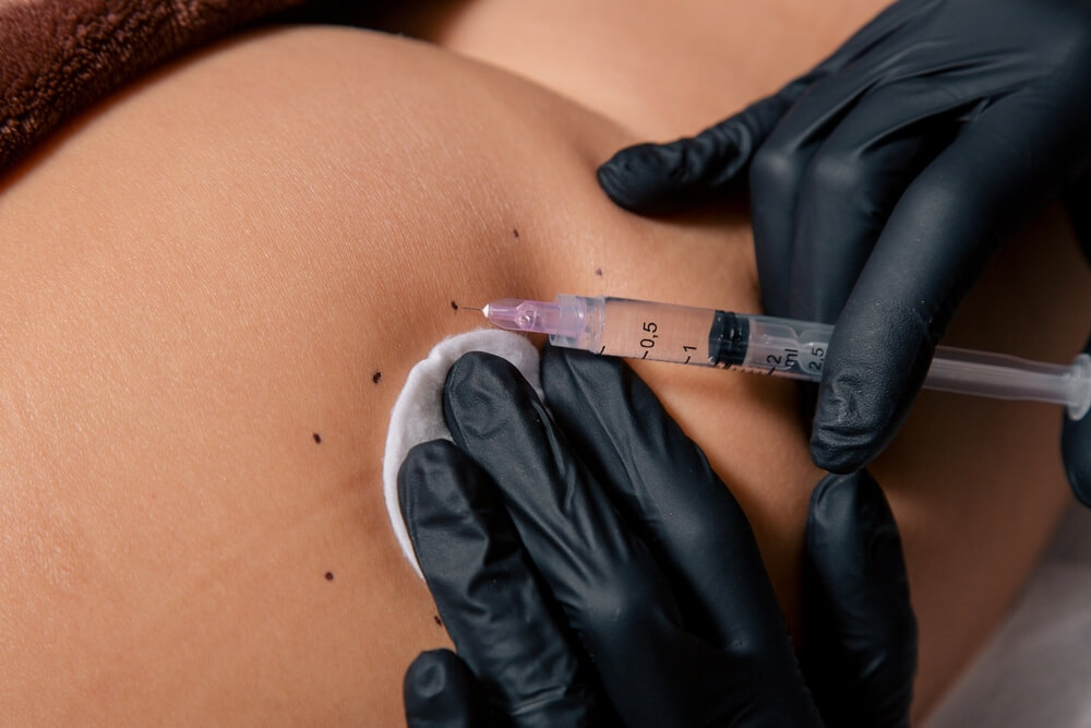 Close-up of Butt Injections procedure showing precision placement of filler for volume enhancement.