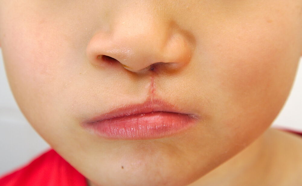 Close-up of a child’s upper lip showing a healed scar after cleft palate surgery to restore normal lip and nasal function.