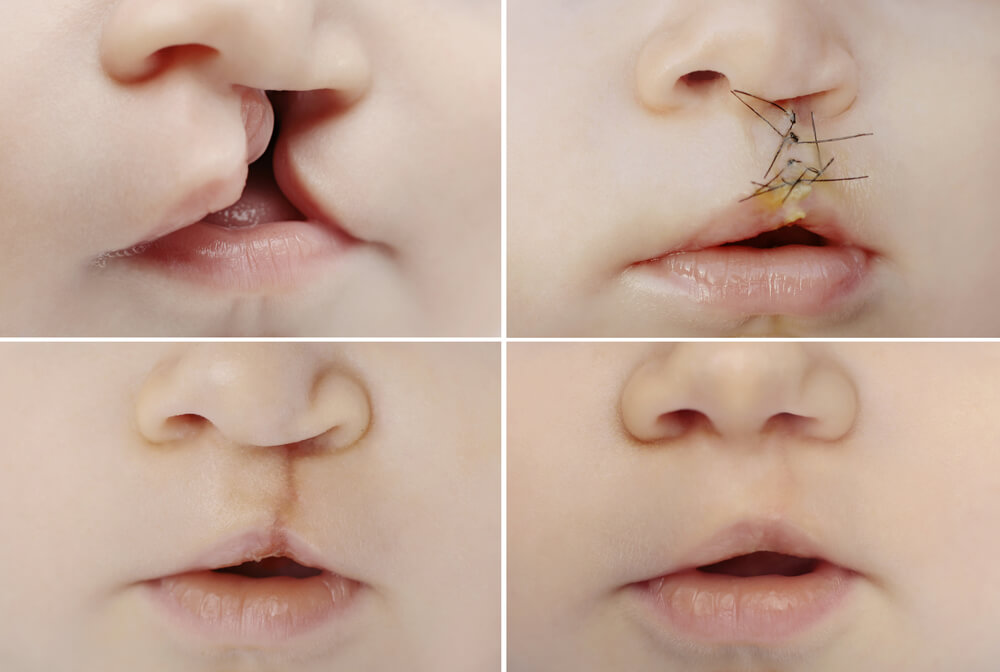 Four stages of cleft palate surgery on an infant, showing lip repair progress from pre-surgery to full recovery.