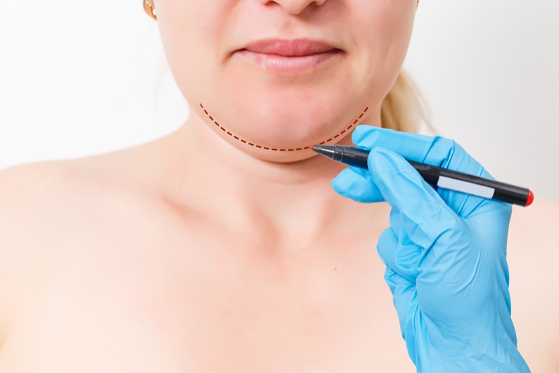 Surgeon marking the treatment area for Chin Augmentation to enhance chin contour and achieve facial symmetry.