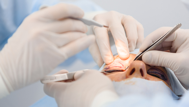 Surgeons performing Blepharoplasty Surgery, Eyelid Surgery to remove excess skin and enhance the patient’s upper eyelids.