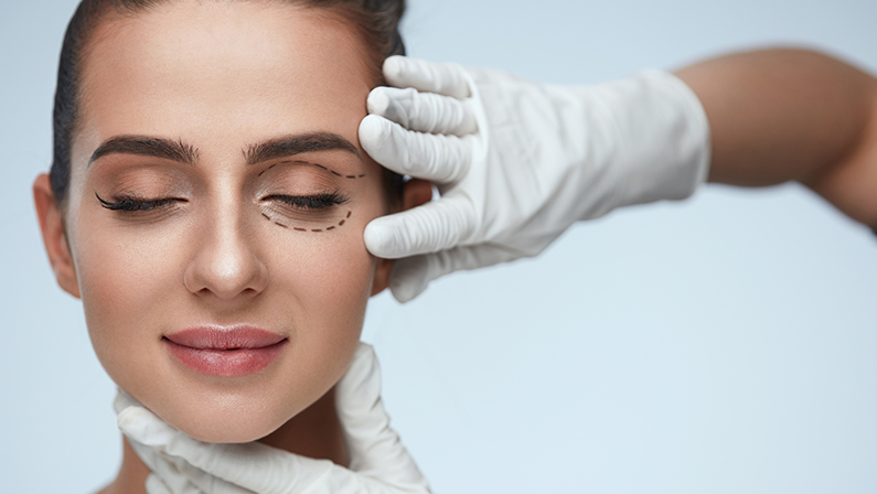 Woman preparing for Blepharoplasty Surgery, Eyelid Surgery with markings drawn under eyes to reduce puffiness and wrinkles.