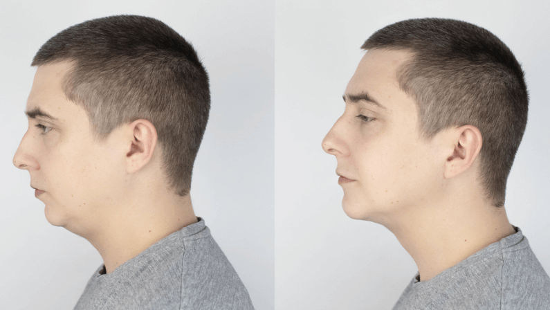 Facelift For Men