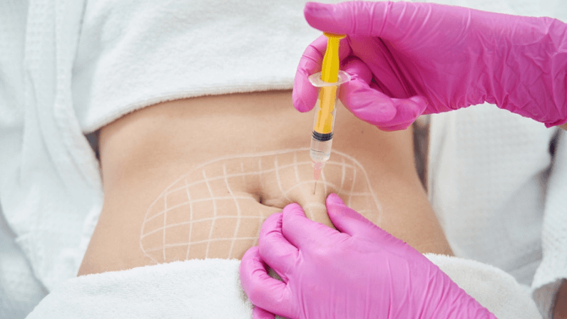 Surgeon injecting marked abdomen area before Liposuction Surgery to remove excess fat and sculpt the body shape.