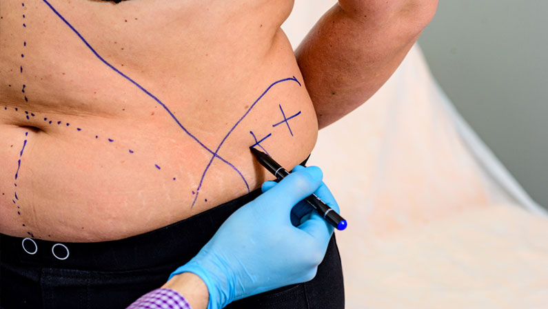 Close-up Of Plastic Surgeon In Blue Gloves Drawing On Woman's Stomach With Pen For Surgery