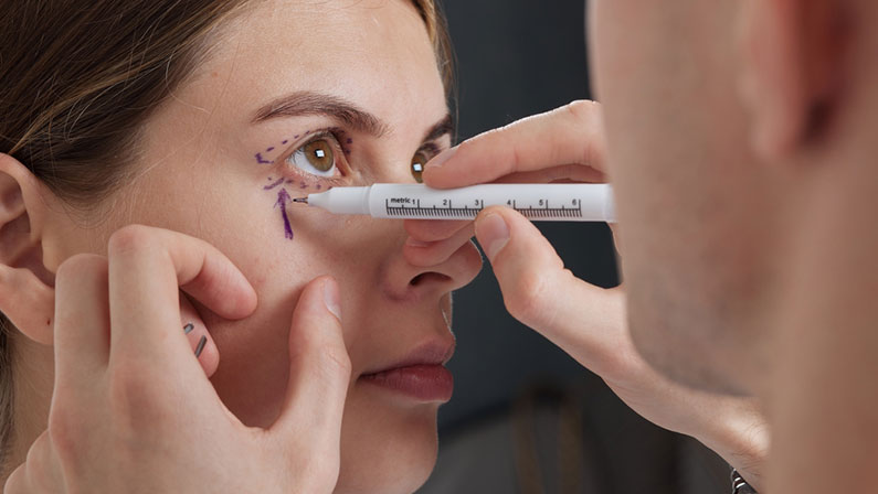 plastic surgeon prepares for Blepharoplasty, Blepharoplasty operation