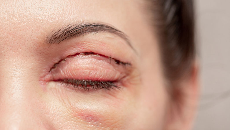 Plastic surgery of the face, skin tightening around the eyes. Surgical procedure to strengthen the skin of the eyelids, remove fatty hernias in the eyes. Operational blepharoplasty.