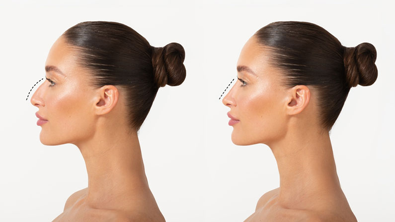 Rhinoplasty before and after. Comparison of female nose after plastic surgery, woman standing isolated on white background, side view