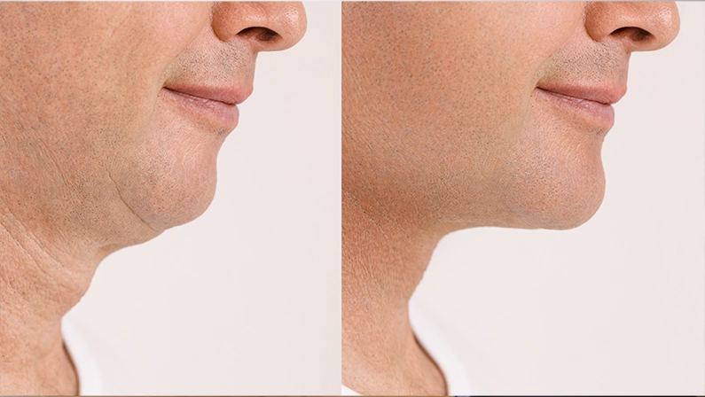 Neck Lift For Men