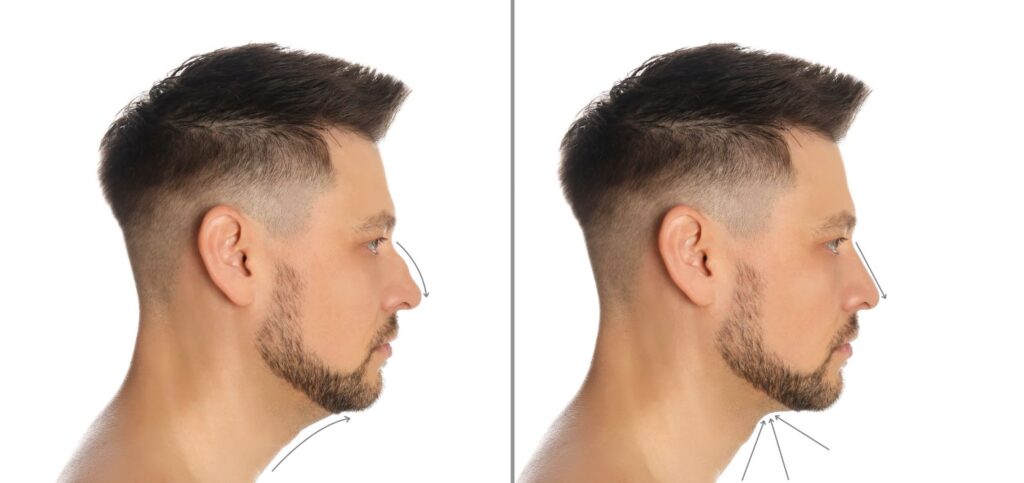 Rhinoplasty for Men