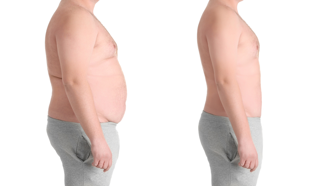 Male body before and after liposuction