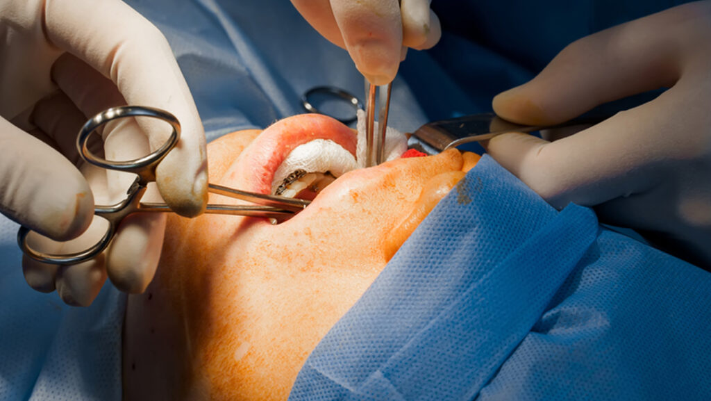 Buccal fat removal. Bisha lumps removal. Plastic surgery in clinic. Plastic surgery operation for modifying face in medical clinic.