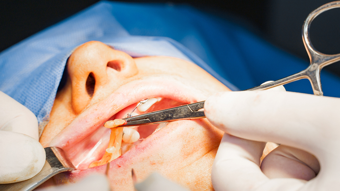 Close-up Buccal fat removal. Bisha lumps removal. Plastic surgery in clinic. Plastic surgery operation for modifying face in medical clinic.