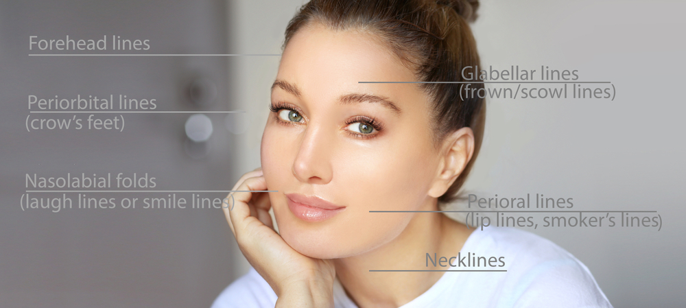 An image showing different types of wrinkles treated with dermal fillers
