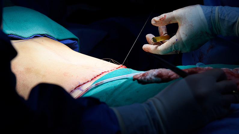 Doctor sewing up stomach skin after a tummy tuck surgery