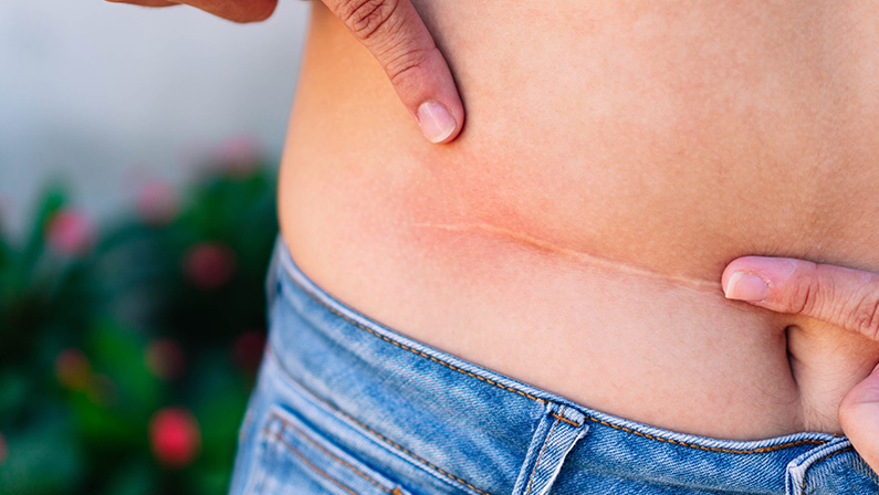 Close-up of a woman pointing at a healed incision line on her side, showing the fading appearance of mommy makeover scars.