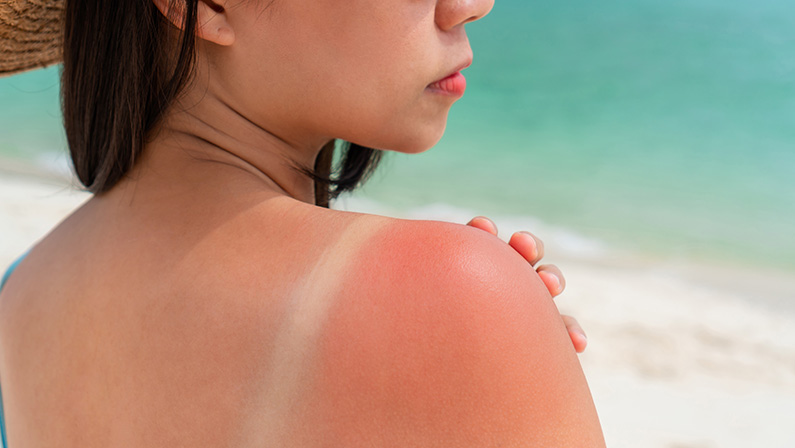 Woman with sunburned shoulder on the beach, emphasizing sun protection to avoid darkening mommy makeover scars.