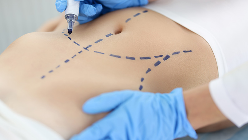 Surgeon marking abdomen area before surgery to improve contour and minimize visibility of future mommy makeover scars.