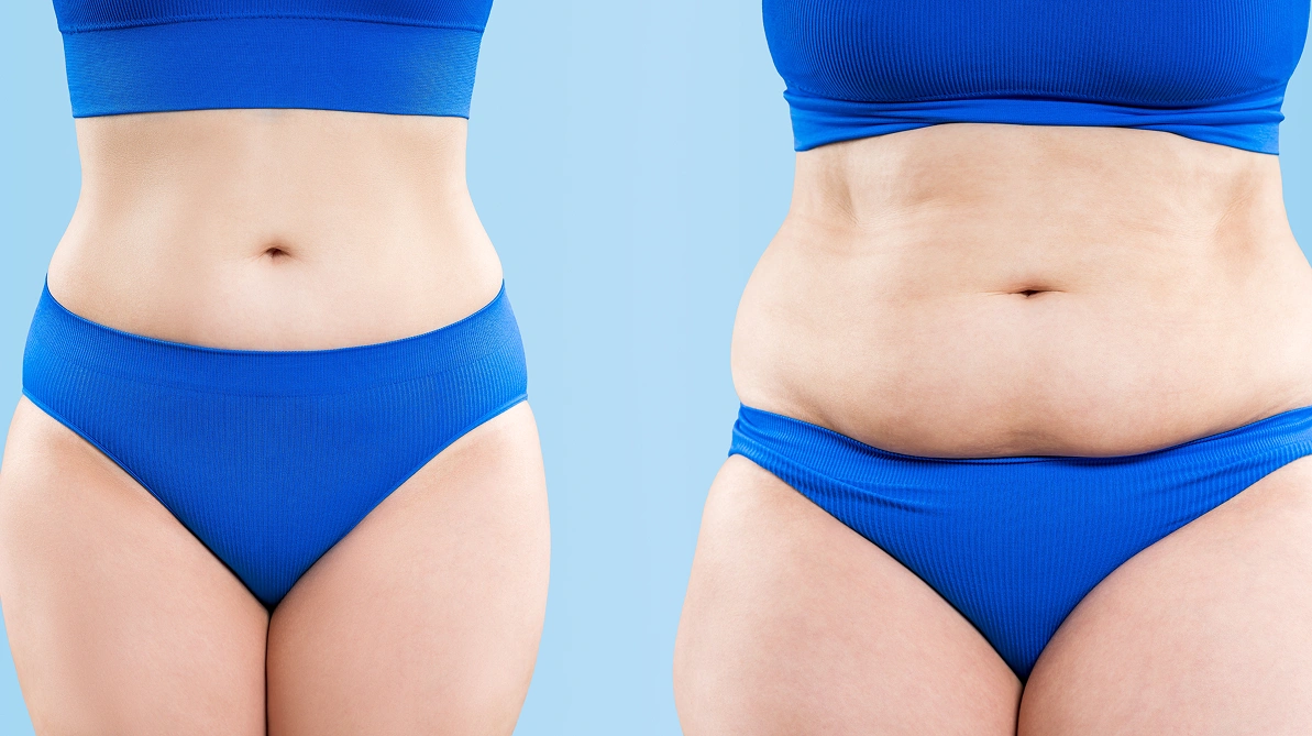 Before and after results showing body contour improvement and reduced fat appearance after tummy tuck recovery time.