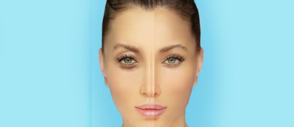 Fat Grafting vs Fillers