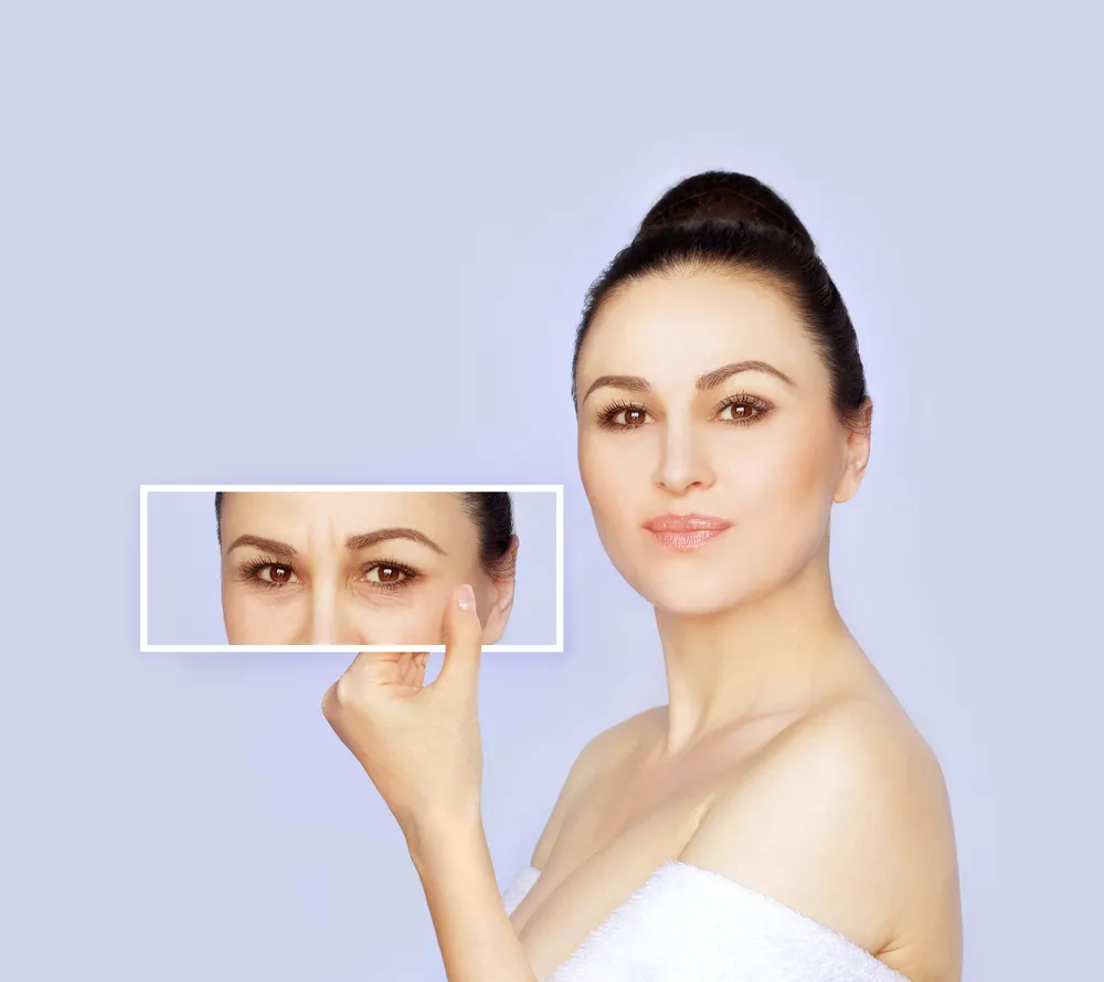 Woman showing before and after results highlighting smoother skin and reduced wrinkles from fillers