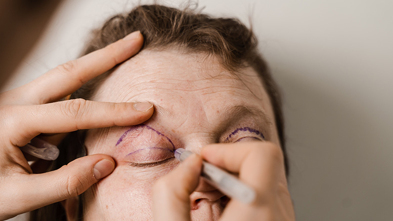 Surgeon marking eyelids before surgery, outlining incision areas where blepharoplasty stitches will later be placed.