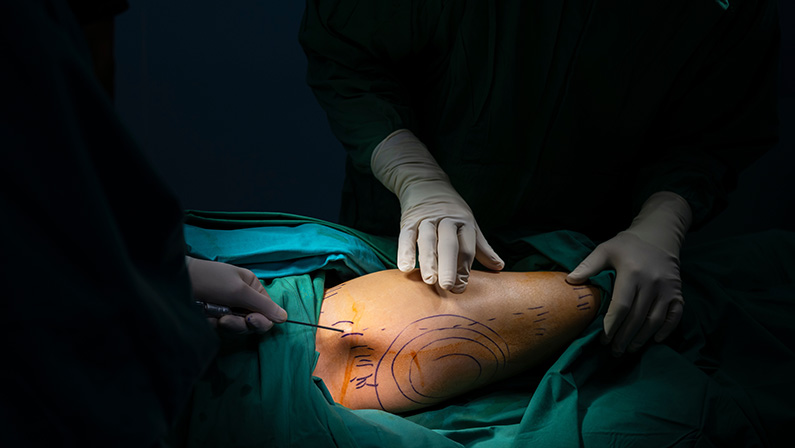 Female patient with marks on skin lying on medical bed while doctor preparing tools.Plastic surgeons perform liposuction for breast surgery in operating room.Concept of plastic surgery preparation.