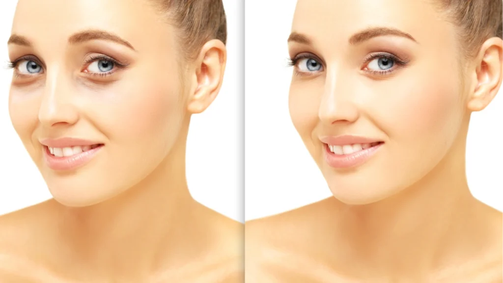 Eyelid Surgery.Brow Lift.upper eyelids.Forehead lift