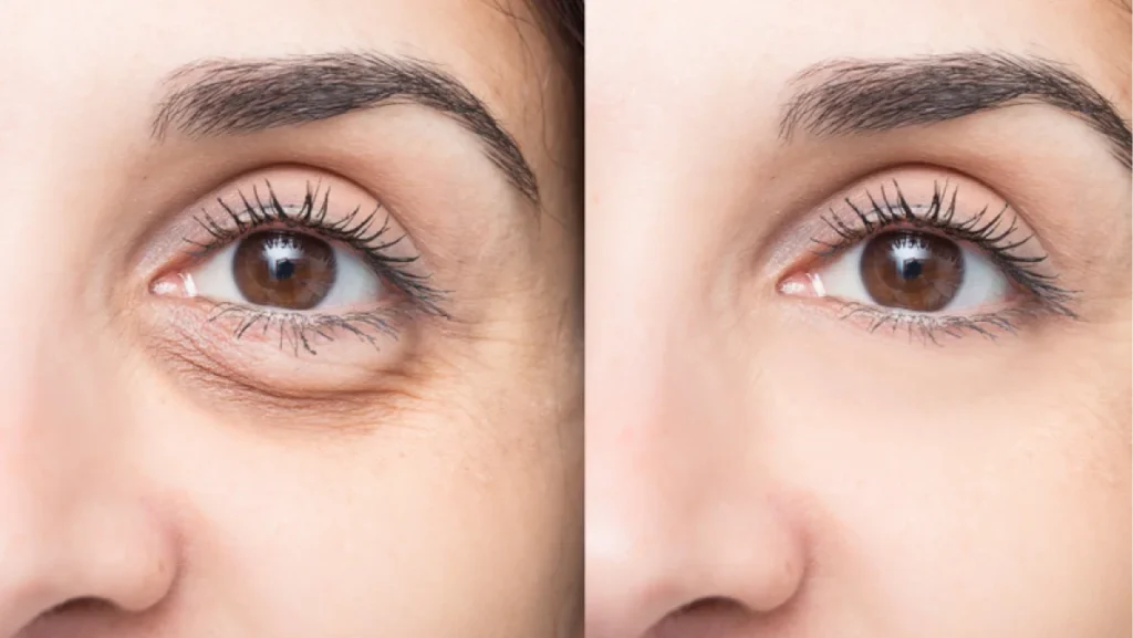 Woman’s eye area before and after under eye filler, highlighting wrinkle reduction and refreshed look.
