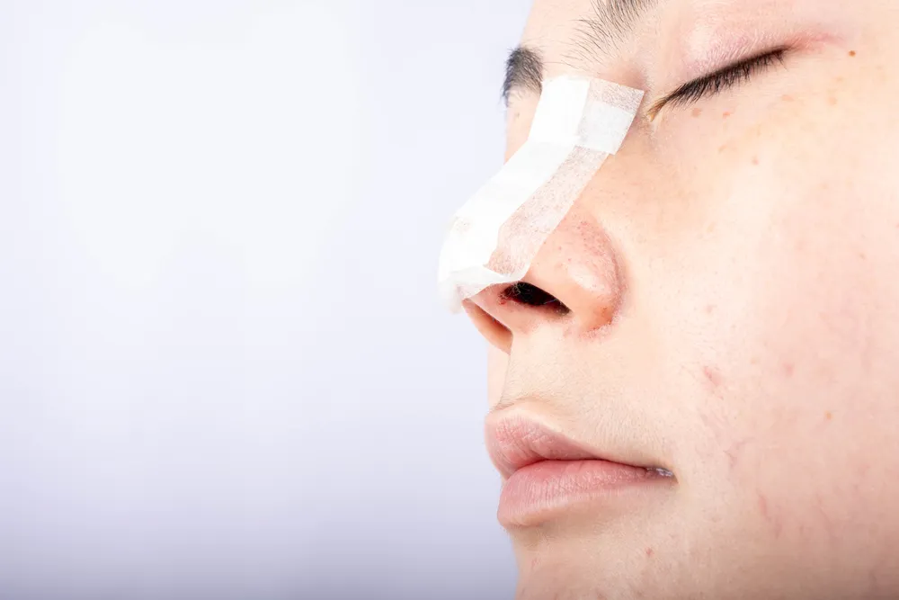 Close-up of healing nose with surgical tape applied, showing recovery progress and reduced rhinoplasty scarring.